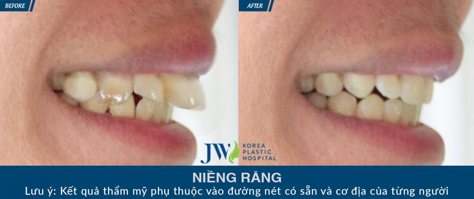 điều trị hô do răng với phương pháp niềng răng chỉnh nha - hình 1