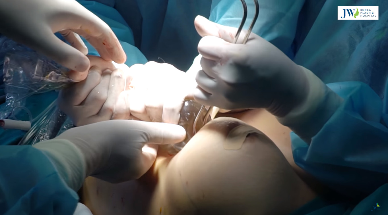 Hiểu đến 99% về nâng ngực nội soi bằng đường dưới nếp vú -hình 3