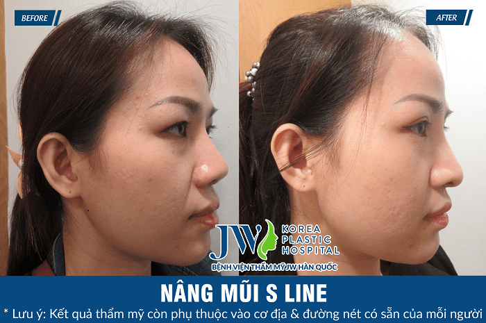Có nên nâng mũi S Line không-hình 6