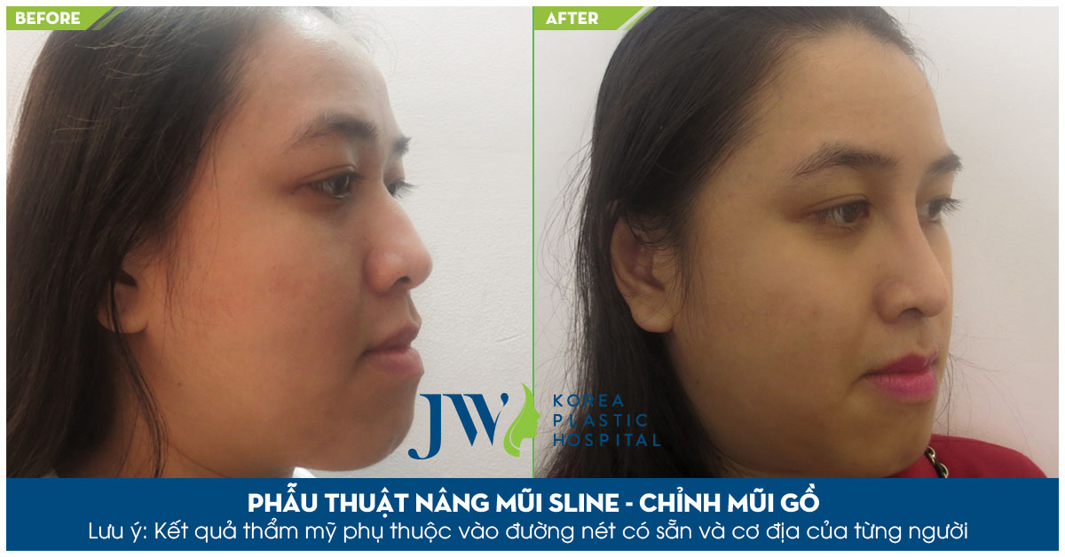 Bí quyết sửa mũi gồ an toàn và chuẩn đẹp-hình 8