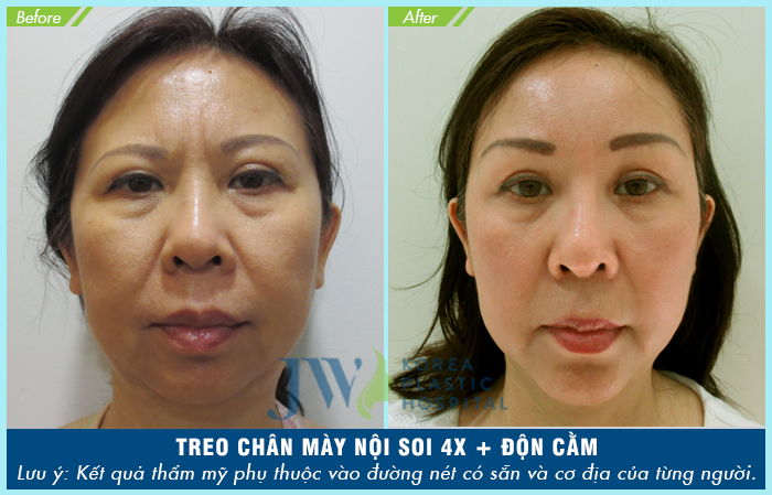 Treo chân mày có tác dụng gì? Nên thực hiện ở đâu?-hình 7