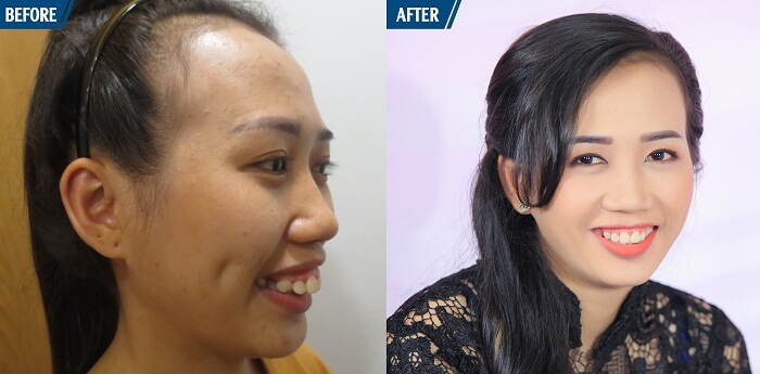 điều trị hàm hô móm không cần niềng răng - hình 3