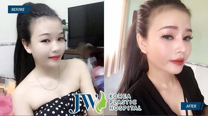 4 Điều không thể bỏ lỡ khi nâng mũi bằng sụn nhân tạo - Ảnh 6