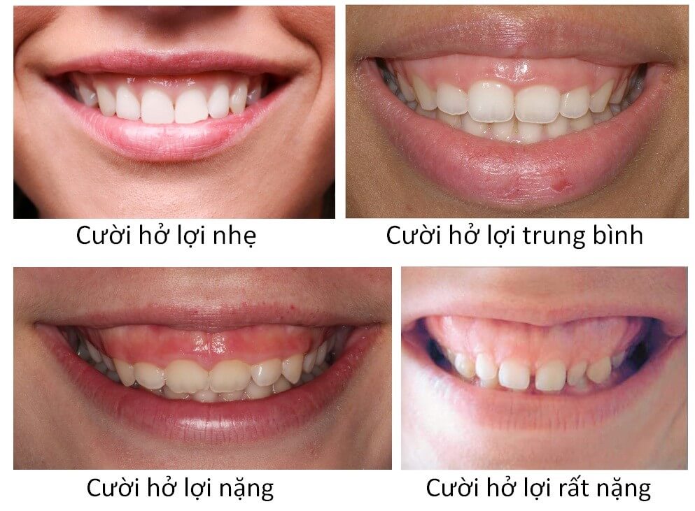 cuoi-ho-loi