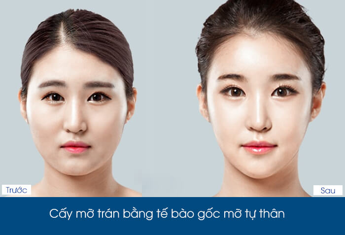 Cấy tế bào gốc là gì, có tác dụng như thế nào-hình 5