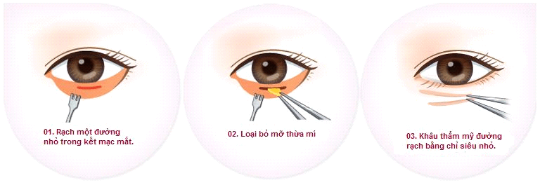 Cắt bọng mắt dưới có đau không - hình 3