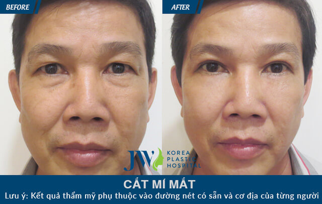 Cắt mí mắt dưới có hại không, sau bao lâu thì lành - hình 5