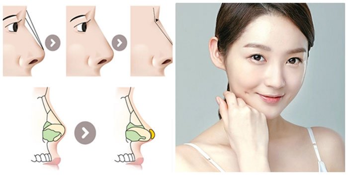 Tại sao nên nâng mũi sụn mềm Hàn Quốc-hình 3