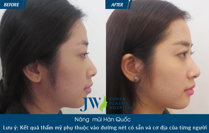 Tại sao nên nâng mũi sụn mềm Hàn Quốc-hình 8