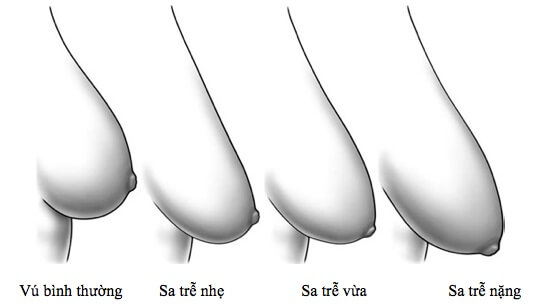 Phẫu thuật nâng ngực chảy xệ sau sinh giá bao nhiêu-hình 2