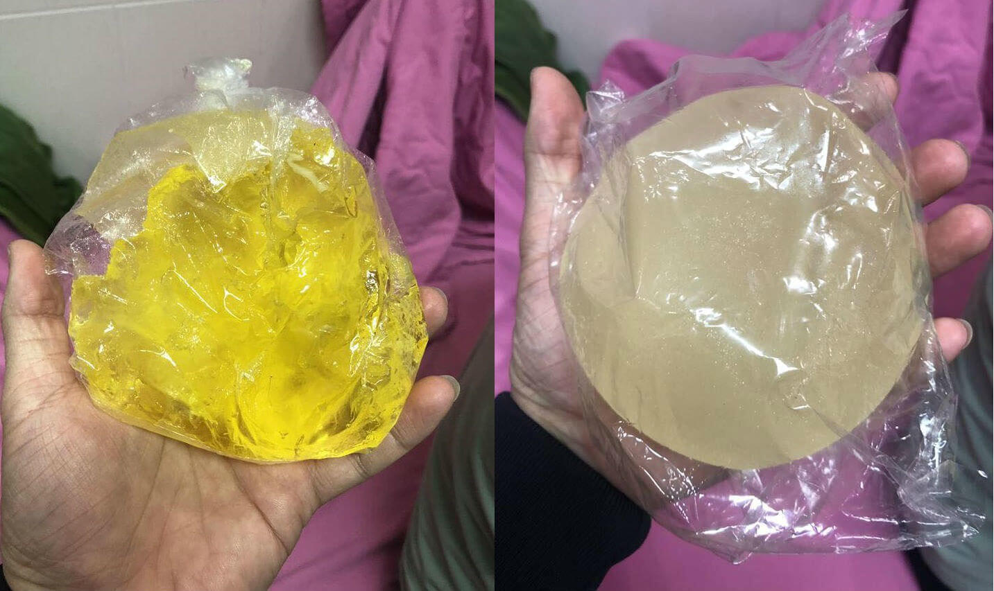 vỡ túi ngực trên máy bay