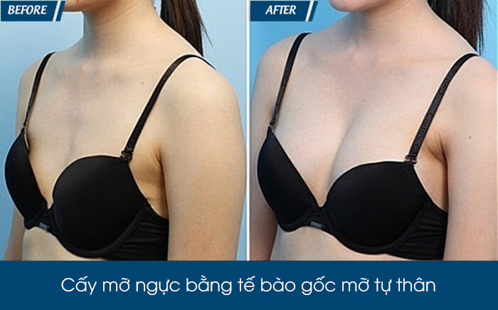 Nâng ngực bằng mỡ tự thân có bền không - hình 5