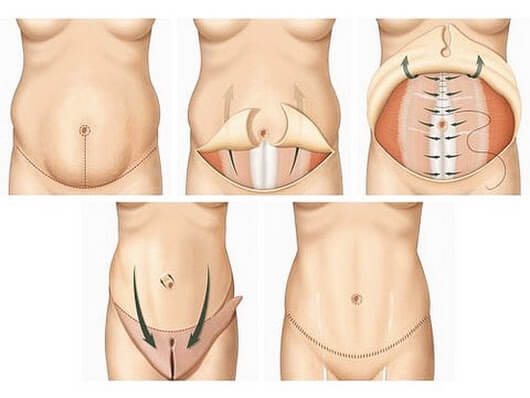 Căng da bụng nội soi giá bao nhiêu -hình 2
