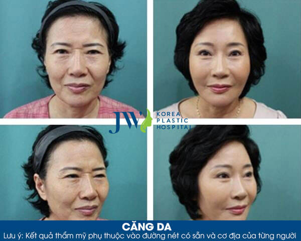 Căng da mặt được bao lâu - hình 4