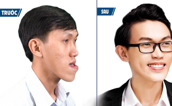 Chữa móm bằng cách nào an toàn và hiệu quả nhất - hình 4
