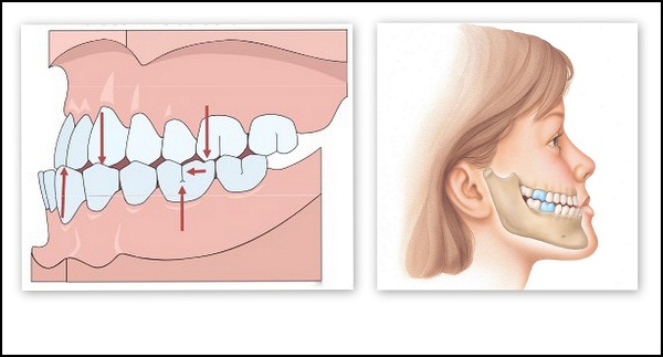 Hàm móm có di truyền không - hình 2