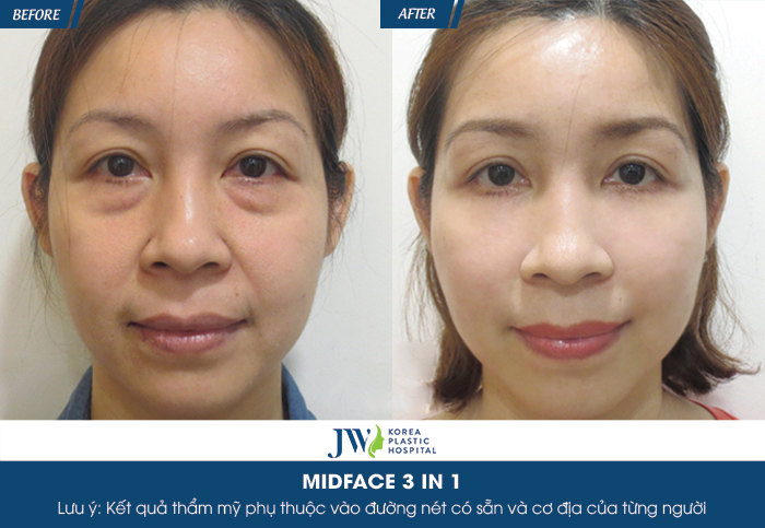 midface1