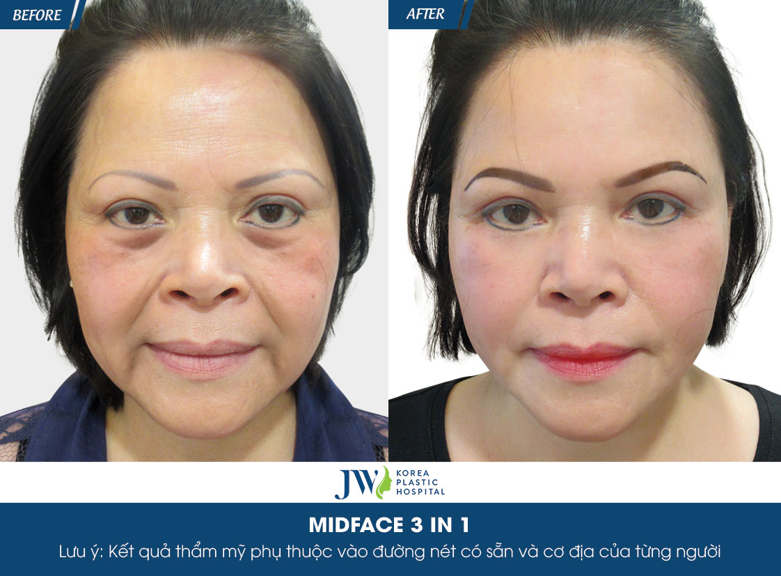 midface2