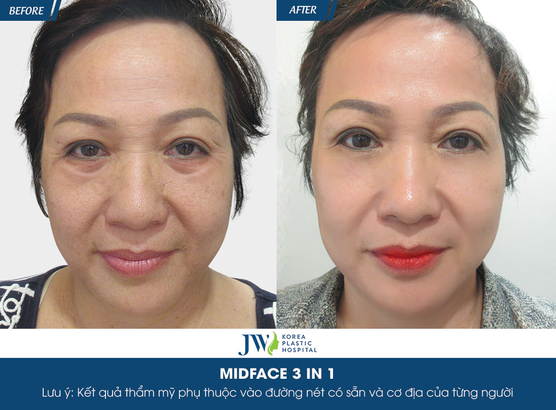 midface3