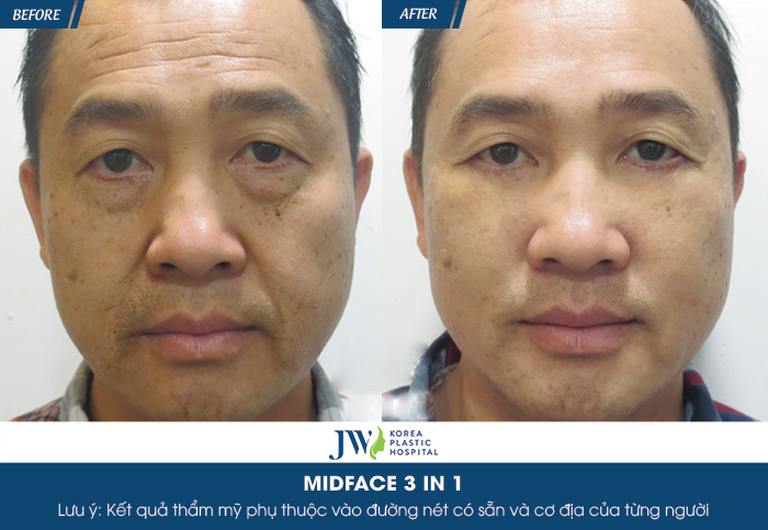 midface4