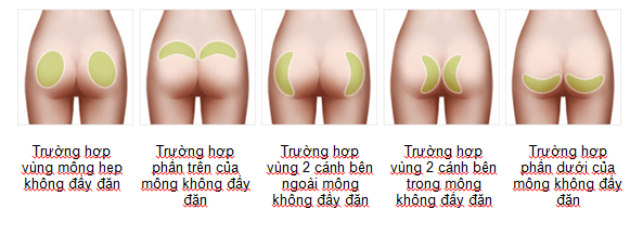 Quy trình nâng mông nội soi 4.0