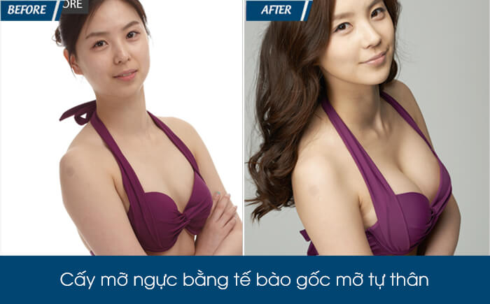 Nâng ngực bằng mỡ tự thân có tốt không - hình 5