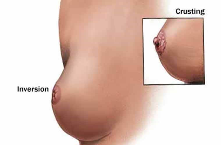 Phẫu thuật kéo núm vú bị tụt - Bí quyết đơn giản tự tin trong "chuyện ấy"