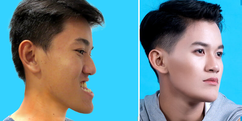 Chữa hàm móm bằng phương pháp nào - hình 5
