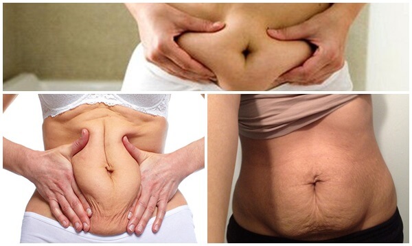 Giải pháp khắc phục da bụng chùn nhão sau sinh - hình 2