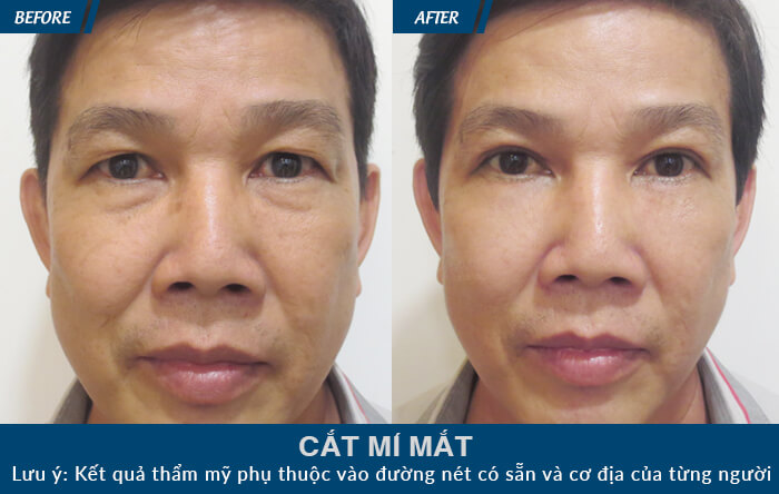 Cắt mí mắt cho nam khác gì so với nữ giới- hình 4
