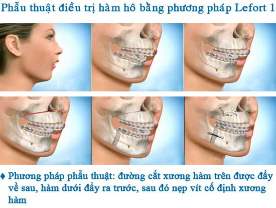 Niềng răng hô hàm trên giá bao nhiêu?Bảng giá mới nhất 2018_2