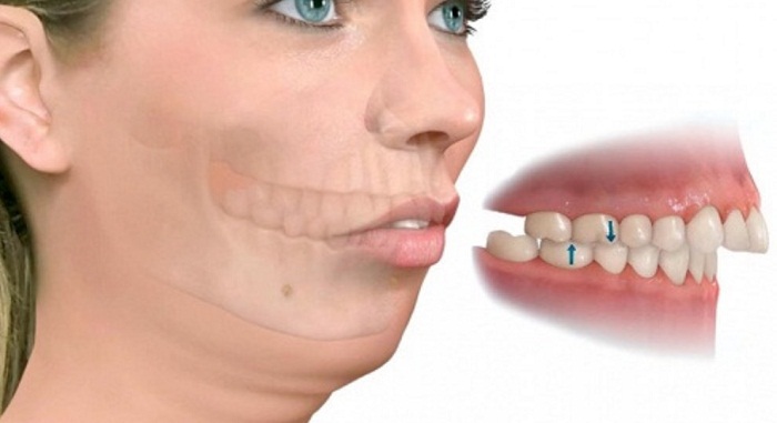 Hô hàm cần phải can thiệp phẫu thuật 1 lần duy nhất mới mong mang lại hiệu quả.