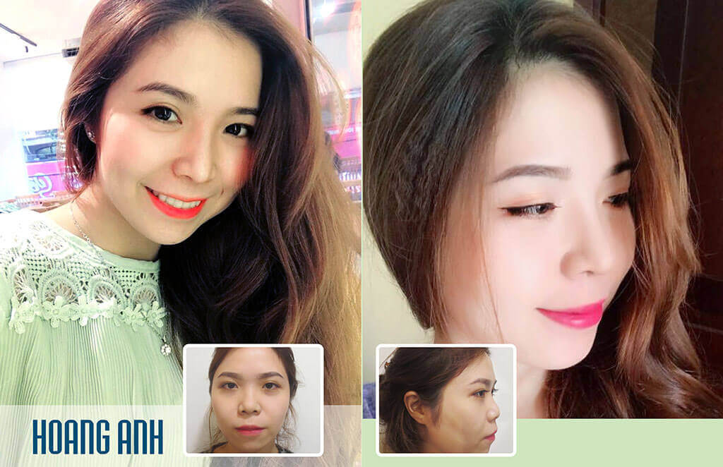 nhung-cach-nang-mui-cao-tu-nhien-sieu-hot-tai-han-quoc-7