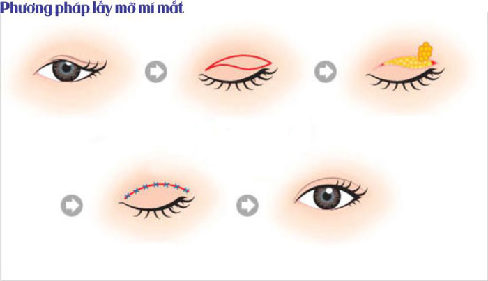 Lấy mỡ mí mắt có nguy hiểm không? Có đau nhiều hay không - hình 2