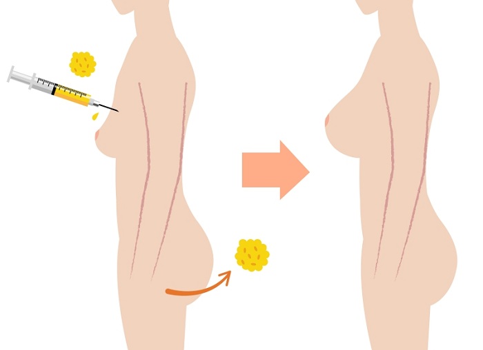 Ảnh mô phỏng tiến trình nâng ngực bằng tế bào mỡ tự thân.