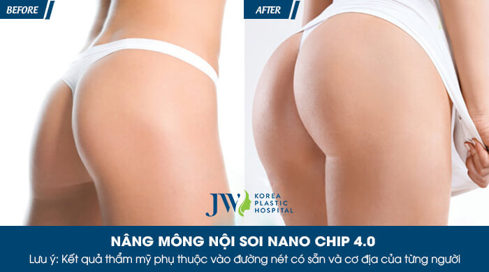 Nâng mông ở đâu đẹp nhất tại TP.HCM?_7