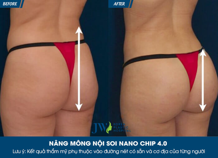 Nâng mông ở đâu đẹp nhất tại TP.HCM?_8