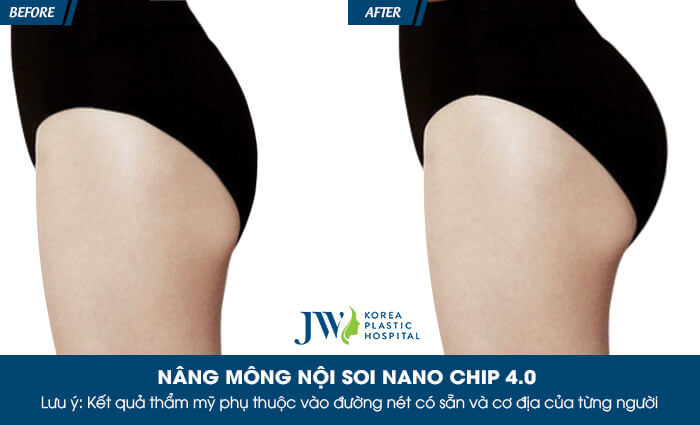 Nâng mông ở đâu đẹp nhất tại TP.HCM?_9