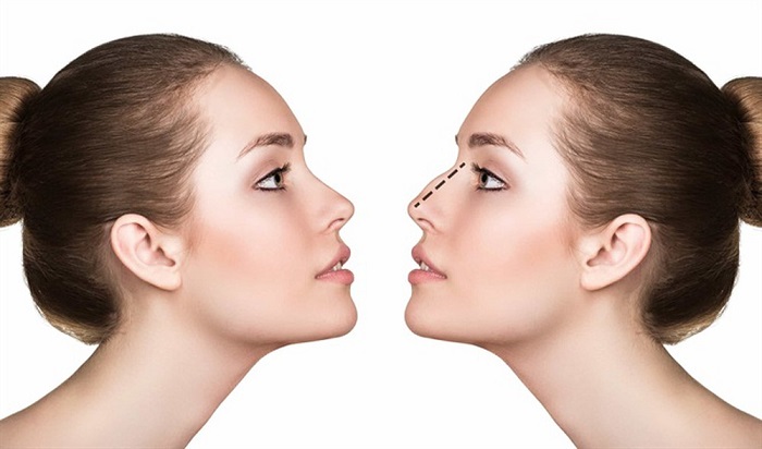 nâng mũi bị biến chứng