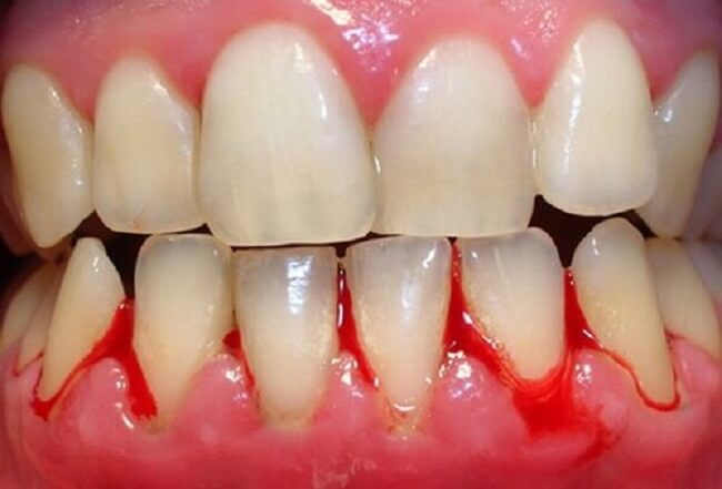 Viêm nha chu nặng không nên can thiệp niềng răng.