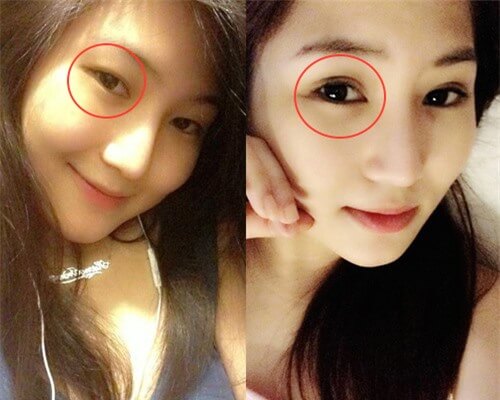 cắt mí mắt có ảnh hưởng gì đến tướng số không