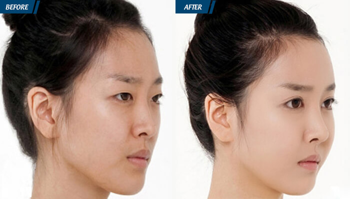 Công nghệ cấy mỡ tự thân hiện đại giúp khách hàng có được gương mặt trẻ trung như mong đợi.