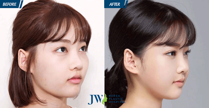 Khách hàng sở hữu gương mặt cân đối nhờ phẫu thuật hạ gò má.