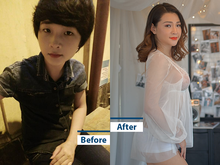 Thoại Vy trước và sau khi phẫu thuật chuyển đổi ngoại hình.