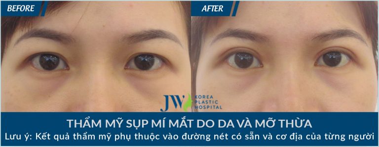 Cắt da thừa mí mắt ở đâu đẹp và an toàn cao - hình 5