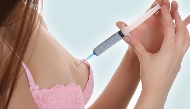 Nâng ngực không phẫu thuật bằng Filler