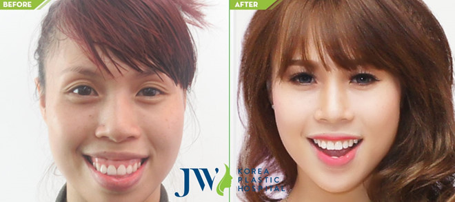 Niềng răng hô hàm trên tại JW
