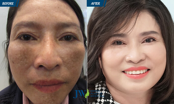 Kết quả thực tế sau khi điều trị nám và tàn nhang tại Bệnh viện JW