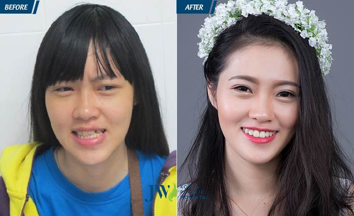 hong-anh