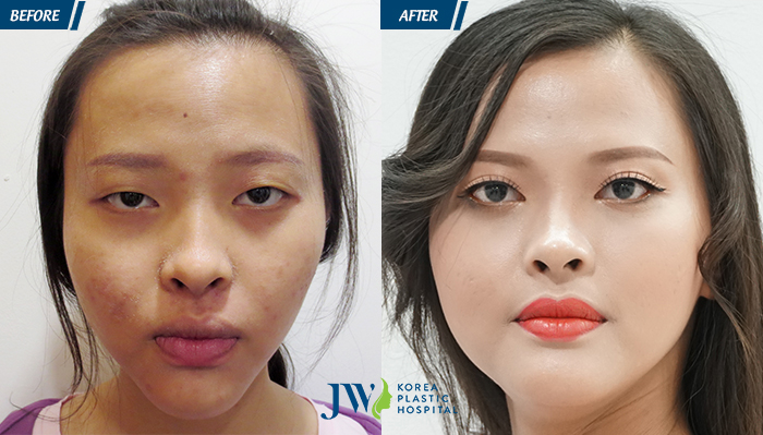 Cắt mí mắt có an toàn không - hình 6